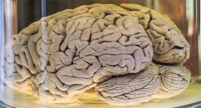 About 100 Brains Missing from University of Texas